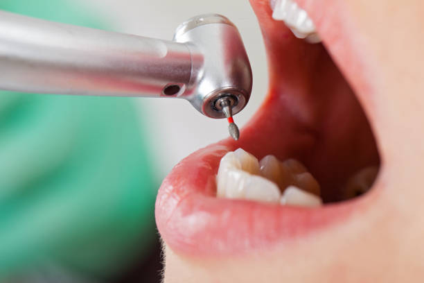 Best Emergency Treatment for Toothache in Poplar Cotton Center, CA